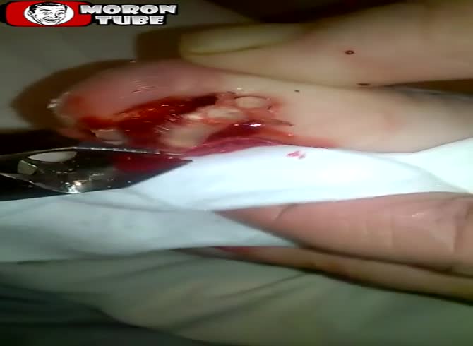 Video :Arf - Removes his nail on camera (Warning to the audience)